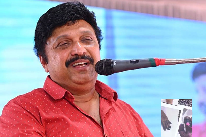 കൊഴുപ്പ് നീക്കൽ ശസ്ത്രക്രിയയ്ക്കിടെ യുവതിക്ക് വിരലുകൾ നഷ്ടമായ സംഭവത്തിൽ പ്രതികരിച്ച് മന്ത്രി കെ.ബി ഗണേഷ് കുമാർ.